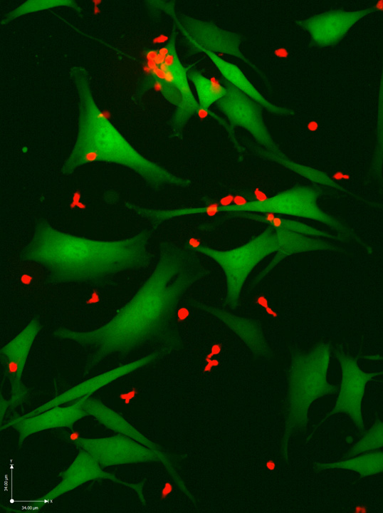 T cells (red) attacking melanoma cells (green). The neo-antigen-specific T cells in this image are especially effective at killing cancer cells Credit: Weizmann Institute of Science