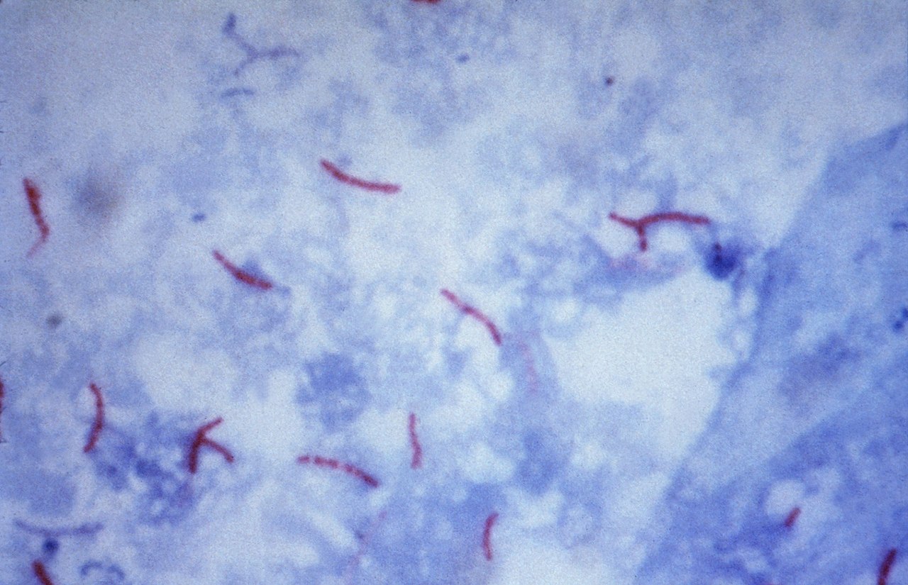 Faster Diagnostic Tests Developed for Tuberculosis
