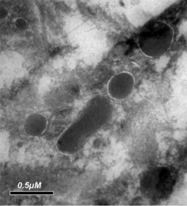This electron microscope image reveals the bacteria living in a tumor cell