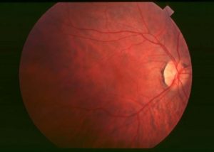 Fundus of patient with retinitis pigmentosa, early stage